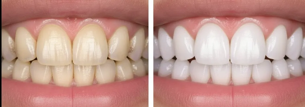 Antes y después de blanqueamiento dental profesional en la Clínica Javier Corzo, Granada