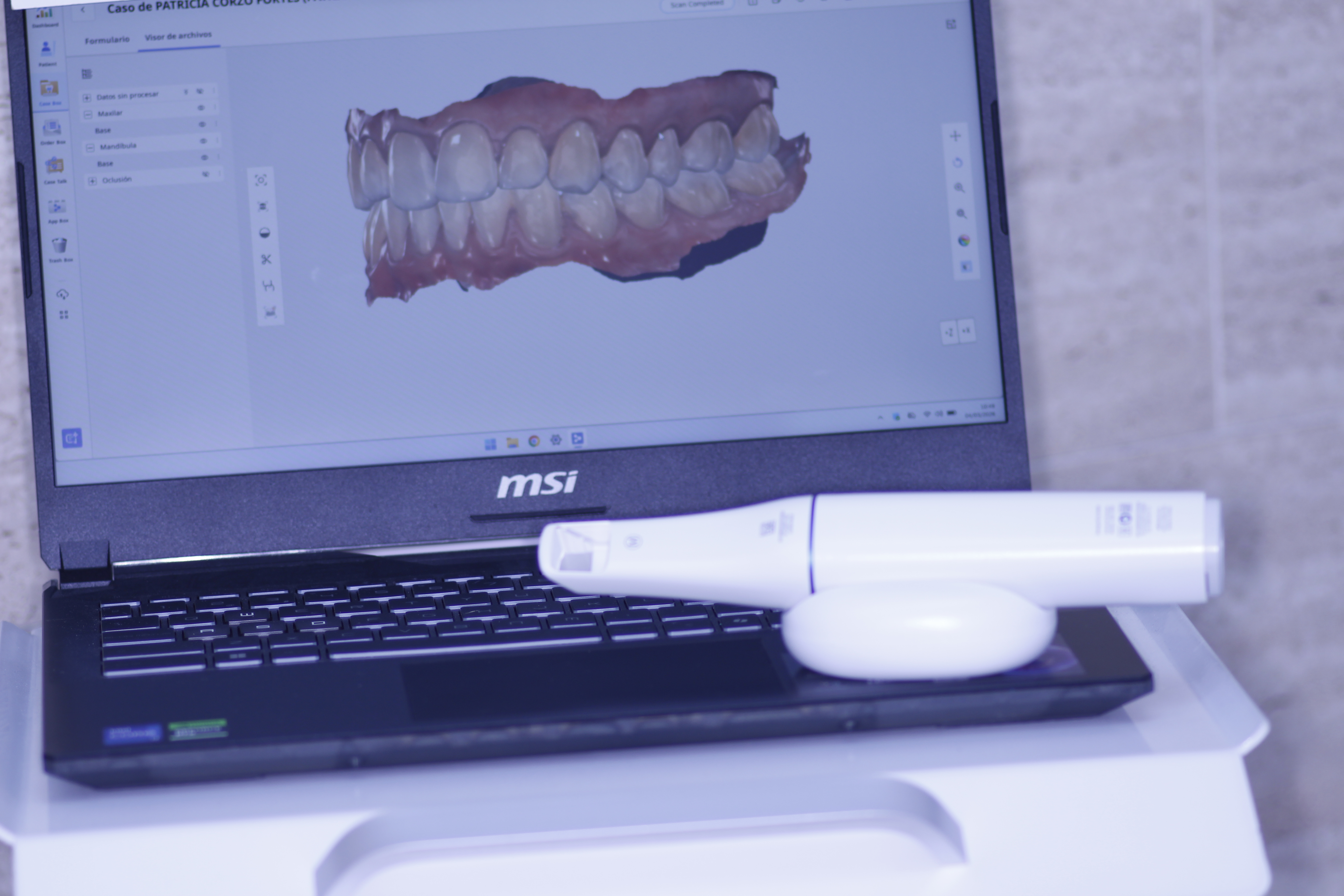 Escáner dental 3D para diagnóstico odontológico en Clínica Javier Corzo, Granada